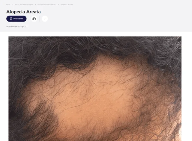 Tela de Atlas de Dermatologia no Whitebook web: Alopecia Areata