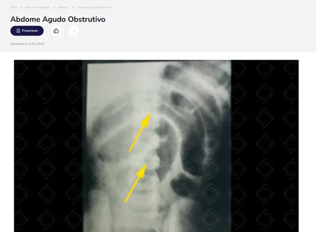 Tela de Atlas de Radiologia no Whitebook web: Abdome Agudo Obstrutivo