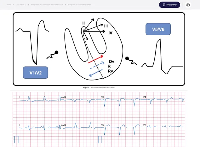 Tela de Guia de ECG no Whitebook web: Bloqueio de Ramo Esquerdo